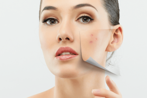 Acne Skin Care